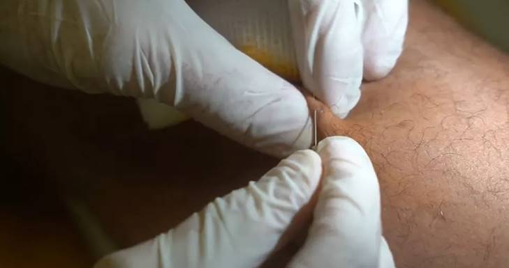 Danilo Fernandes aparece em vídeo retirando estilhaços de vidro do corpo